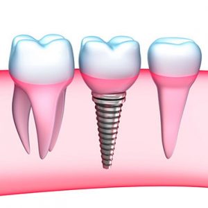 Centre Dentaire St. Laurent Dental Implants Service Image