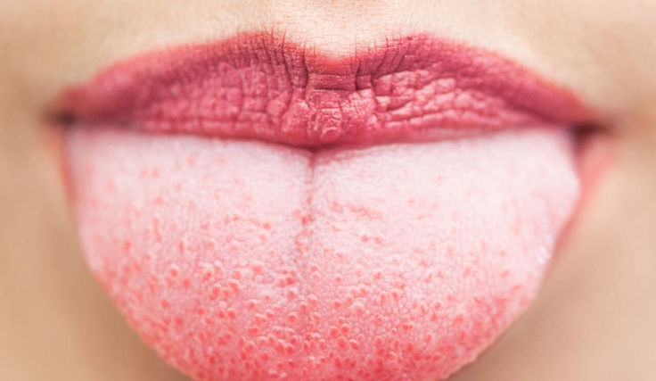 What Causes The White Coating On Your Tongue | | Centre Dentaire St ...