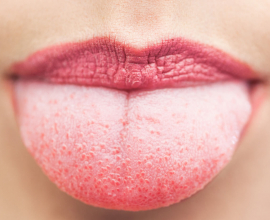 What Causes The White Coating On Your Tongue