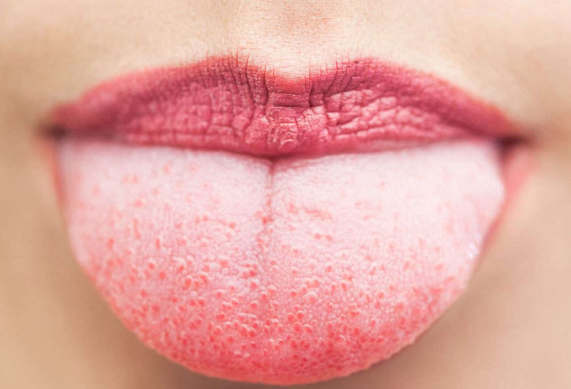 What Causes The White Coating On Your Tongue Centre Dentaire St. Laurent